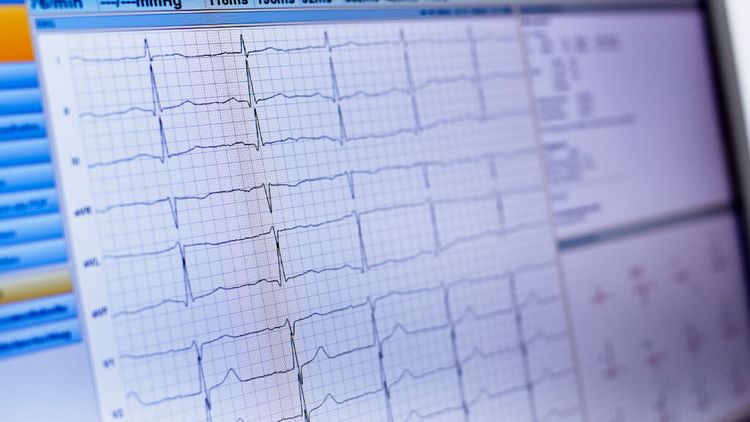 EKG-Verlauf erscheint auf dem Bildschirm